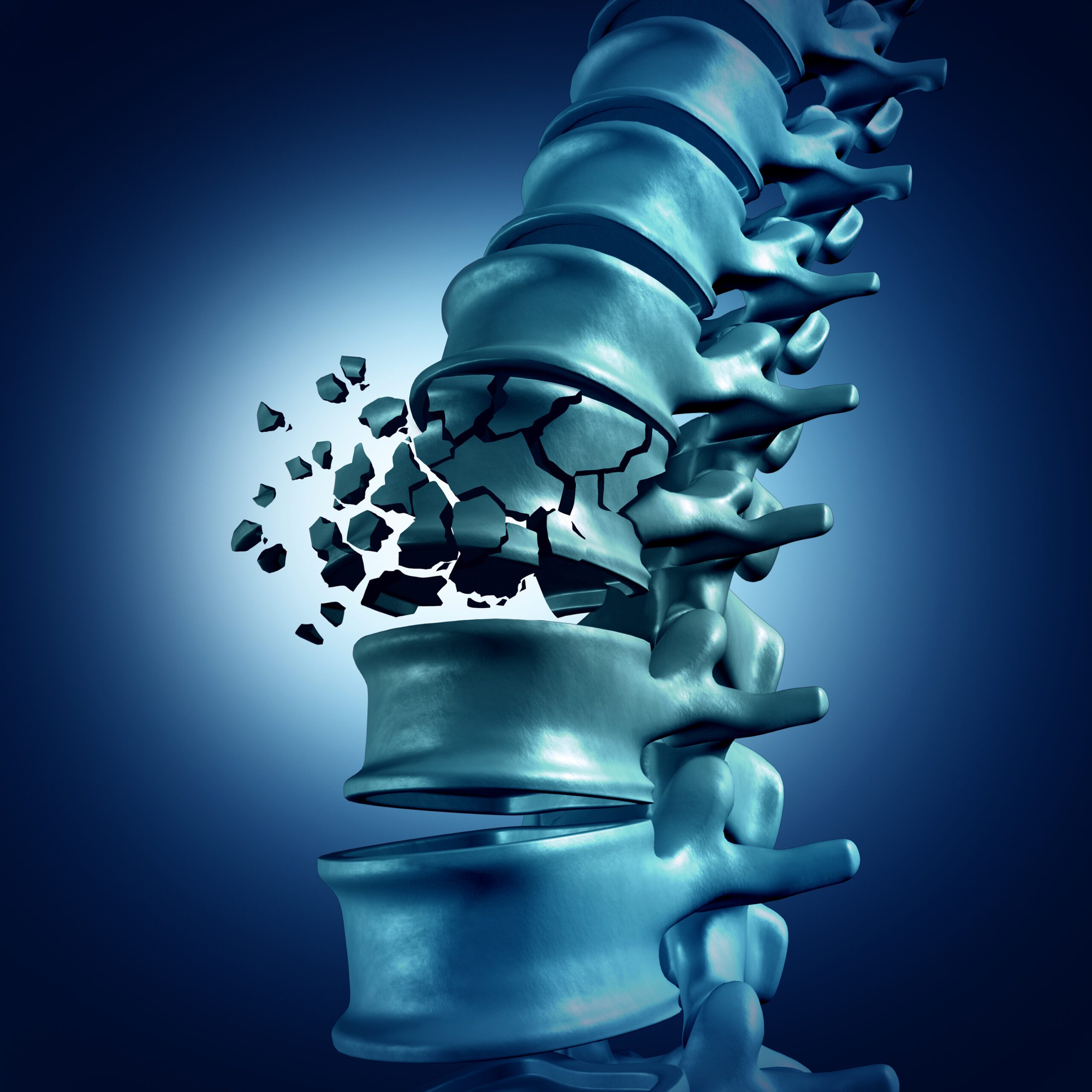 Spinal Fractures in Hollywood & Miami FL